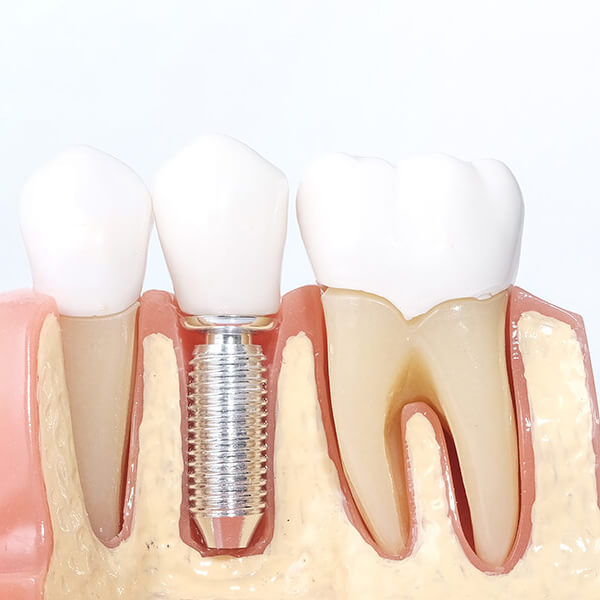 An example of a dental implant on gums 